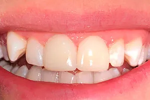 https://clinicadentalbyj.es/wp-content/uploads/2026/05/carillas-dentales-02-1.webp