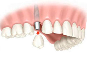 implante dental