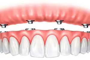 protesis dental