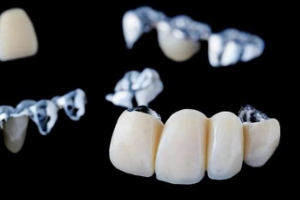 puentes dentales