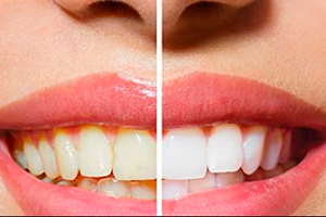 https://clinicadentalbyj.es/wp-content/uploads/2026/06/blanqueamiento-dental-las-gabias-y-la-herradura.webp
