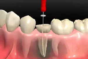 https://clinicadentalbyj.es/wp-content/uploads/2026/06/endodoncia-las-gabias-y-la-herradura.webp
